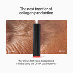 The LYMA Laser