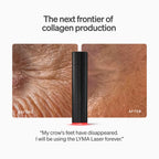LYMA Laser