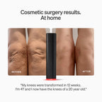 The LYMA Laser